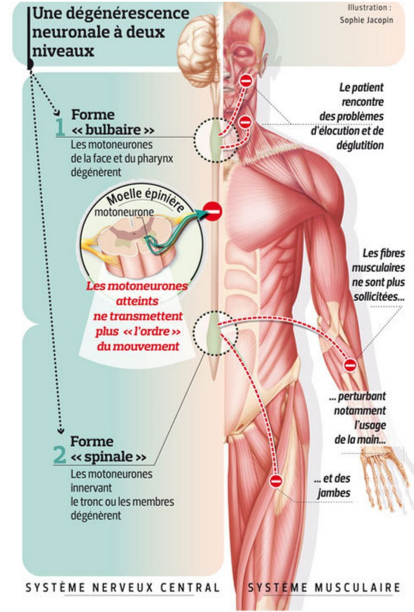 La SLA : sclérose latérale amyotrophique. - Les Menus Services